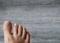 逆生性指甲是「凍甲」?與甲溝炎不一樣?皮膚科醫提4大成因、2大治療方式