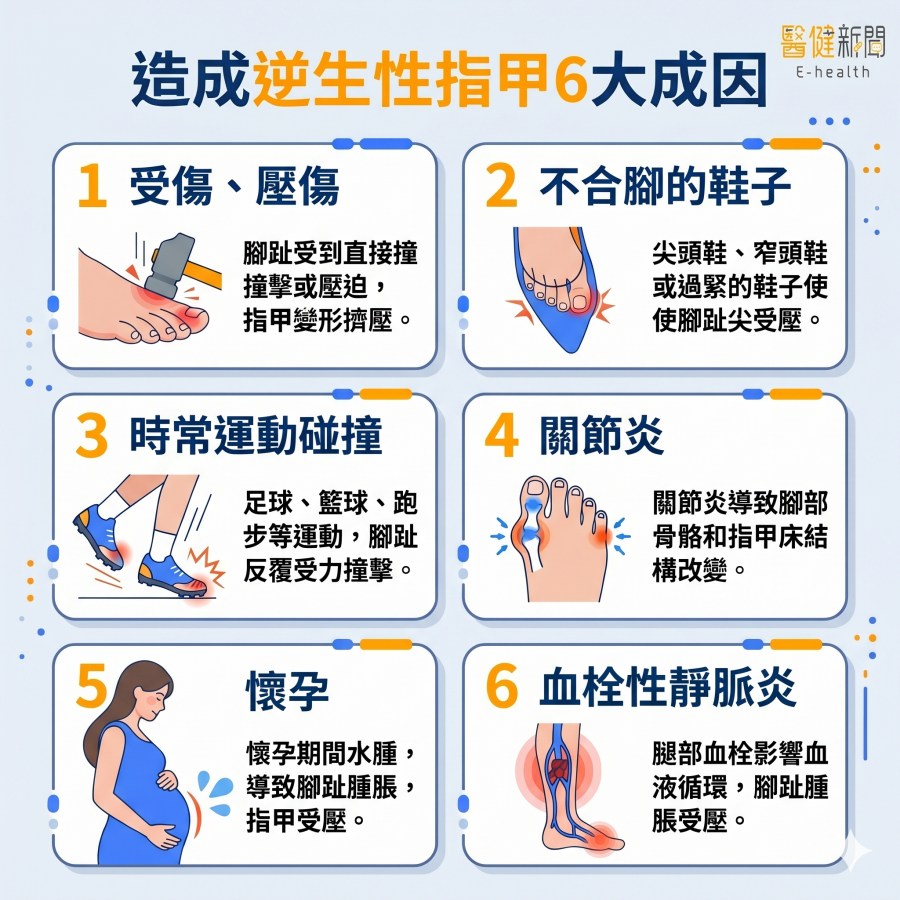 逆生性指甲4大特徵示意圖：趾甲疼痛變形、紅腫化膿、感染症狀