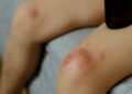 腳上傷口總是不會好？恐是下肢潰瘍！皮膚科醫揭「4大成因」、照護「關鍵」！