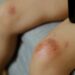 腳上傷口總是不會好？恐是下肢潰瘍！皮膚科醫揭「4大成因」、照護「關鍵」！