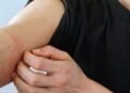蕁麻疹全身癢不停!「1不6要」助舒緩,皮膚科醫:出現「這些」症狀快急診