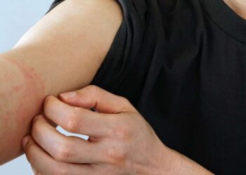 蕁麻疹全身癢不停!「1不6要」助舒緩,皮膚科醫:出現「這些」症狀快急診