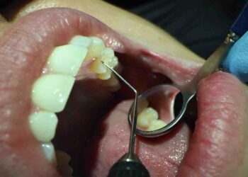 智齒究竟要不要拔？拔牙後得放膠原蛋白嗎？ 牙醫師提供「4關鍵」一次解惑！