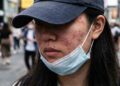 滿臉「痘」花好焦慮！痘疤、凹疤怎處理？誰適合痘疤手術？醫提「4大」關鍵