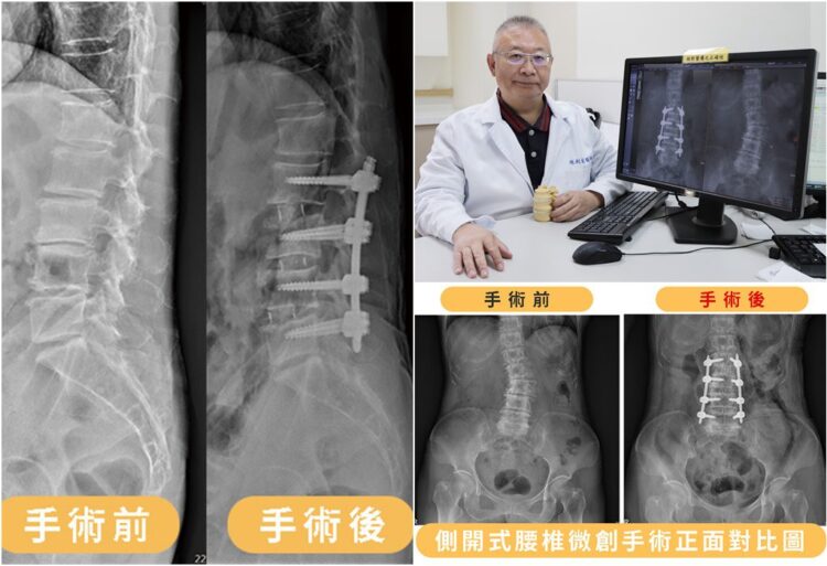 影音∕側開式腰椎微創手術 治癒八旬嬤背痛與駝背